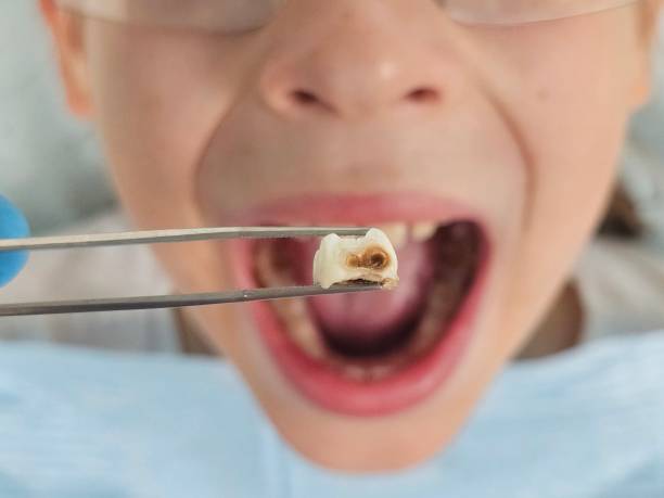 Best Emergency Tooth Extraction in Sulphur Springs, TX